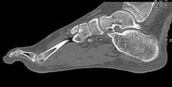 Talus Fracture - CTisus CT Scan