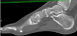 Talus Fracture - CTisus CT Scan