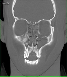 Orbital Fracture - CTisus CT Scan