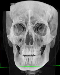 Orbital Fracture - CTisus CT Scan