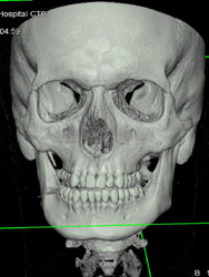 Orbital Fracture - CTisus CT Scan