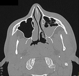 Orbital Fracture - CTisus CT Scan