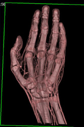 Cellulitis - CTisus CT Scan