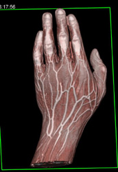 CTA of Hand - CTisus CT Scan