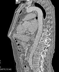 Collapsed T-spine Vertebrae Bodies - CTisus CT Scan