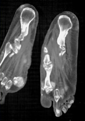 Gout - CTisus CT Scan