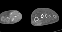 Gout - CTisus CT Scan