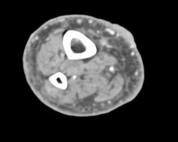 Skin Ulceration - CTisus CT Scan