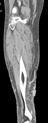 Cellulitis - CTisus CT Scan