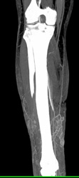 Cellulitis - CTisus CT Scan