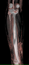 Cellulitis - CTisus CT Scan