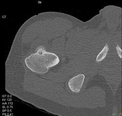 Osteoid Osteoma - CTisus CT Scan