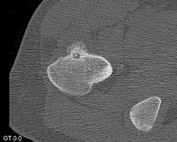 Osteoid Osteoma - CTisus CT Scan