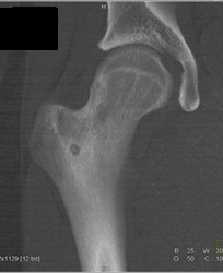 Osteoid Osteoma - CTisus CT Scan