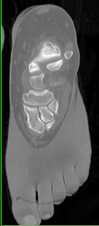 Talus Fracture - CTisus CT Scan