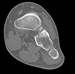 Talus Fracture - CTisus CT Scan