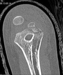 Humerus Fracture - CTisus CT Scan