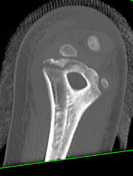 Humerus Fracture - CTisus CT Scan