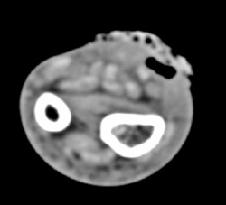 Ulcer and Cellulitis - CTisus CT Scan