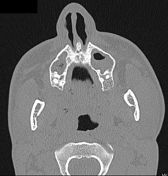 Orbital Fracture - CTisus CT Scan