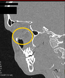 Orbital Fracture - CTisus CT Scan