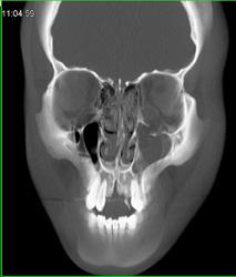 Orbital Fracture - CTisus CT Scan