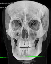 Orbital Fracture - CTisus CT Scan