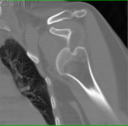 Fracture and Dislocation - CTisus CT Scan