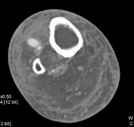 Cellulitis - CTisus CT Scan