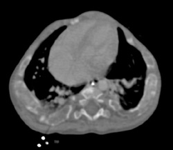 Osteogenesis Imperfecta - CTisus CT Scan