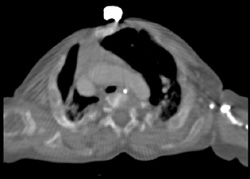 Osteogenesis Imperfecta - CTisus CT Scan