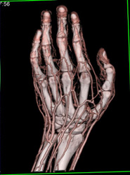 Cellulitis - CTisus CT Scan