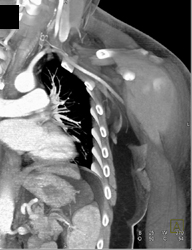 Axilla Artery Without Bleed Status Post Trauma - CTisus CT Scan