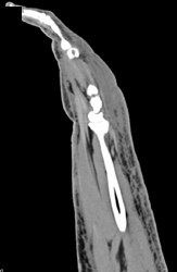 Ulcer on Skin With Cellulitis - CTisus CT Scan