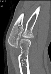 Cystic Changes Radius and Subtle Fracture - CTisus CT Scan