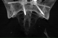 Fusion of SI Joints - CTisus CT Scan