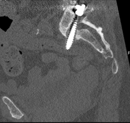 Screw Extends Beyond Foramen - CTisus CT Scan