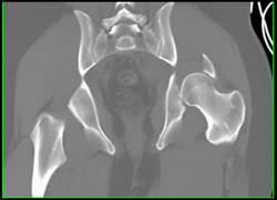 Acetabular Fracture With Dislocation - CTisus CT Scan