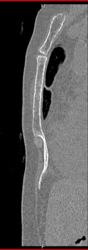 Variation of the Sternum - CTisus CT Scan