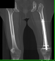 Intramedullary Rod - CTisus CT Scan