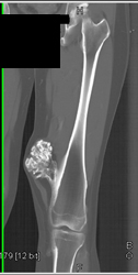 Exostosis in Multiple Hereditary Exostosis - CTisus CT Scan