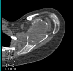 Myeloma - CTisus CT Scan