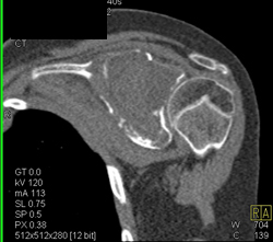 Myeloma - CTisus CT Scan