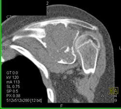 Myeloma - CTisus CT Scan