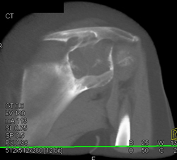 Myeloma - CTisus CT Scan