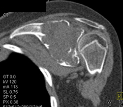 Myeloma - CTisus CT Scan