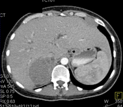 Lymphoma With Nodes and Subcutaneous Nodules - CTisus CT Scan