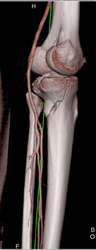 Tibial Fracture Without Vascular Injury - CTisus CT Scan