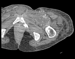 Intramuscular Abscess With Necrosis - CTisus CT Scan