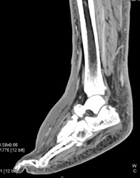 Cellulitis - CTisus CT Scan